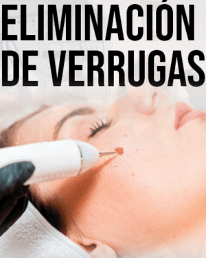 Curso de Eliminación de Verrugas